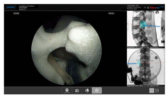joimax Intracs em, navigation, endoscopic devices, electronic, workflow, navigation of instruments, reamer