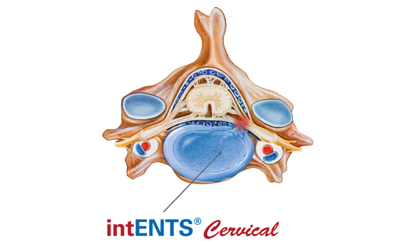 endoskopic spine surgery, endoscopy, spinal colum, vaporflex, legato, endovapor, RF-HF, endoscopic devices