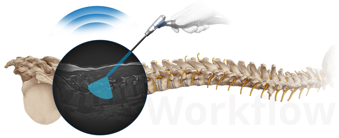 joimax Intracs em, navigation, endoscopic devices, electronic, illustration, key visual, spine, field of view, endoscope, electromagnetic wave, workflow