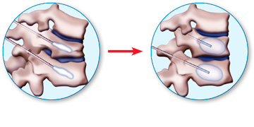 spinal_disorder_compression_fractures01