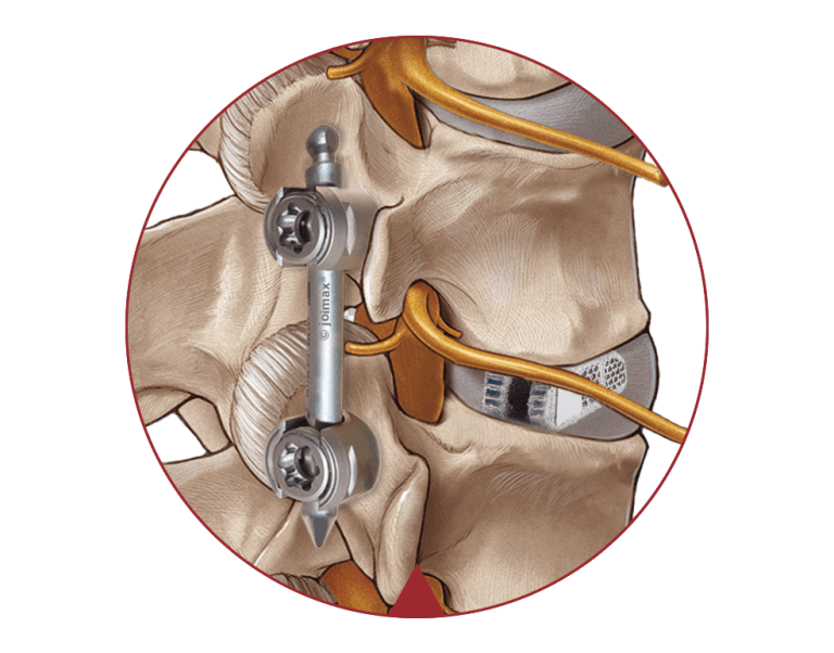 EndoLIF Endoscopic Lumbar Interbody Fusion