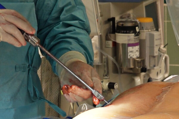 EndoLIF-Surgery