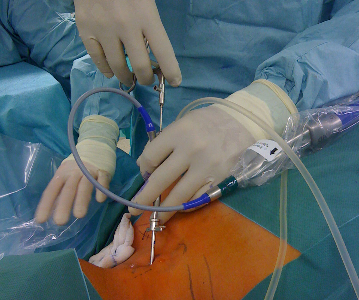 Zervikale-intradiskale-Dekompression