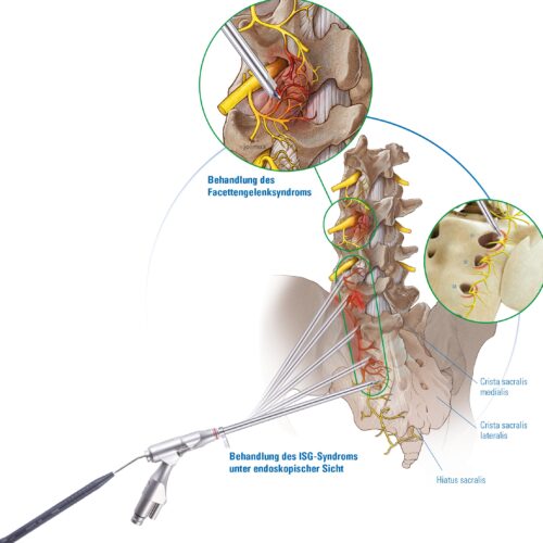 Illustration that shows the treatment of ISG- Syndrome from an endoscopic perspective.