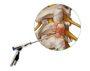 MultiZYTE-Facet-Cervical_Access-Illustration