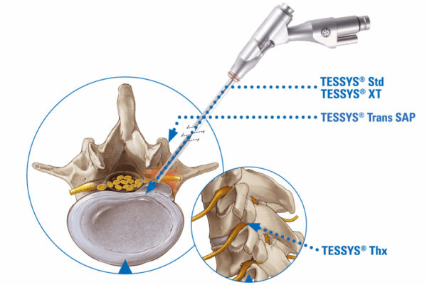 Application Area_Anwendungsgebiet_Transforaminal transforaminal endoscopic discectomy with the TESSYS Transforaminal Surgical System by joimax