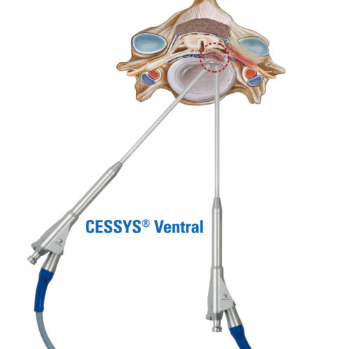 CESSYS-Ventral-Access-Zugang CESSYS-Ventral-Access-Zugang