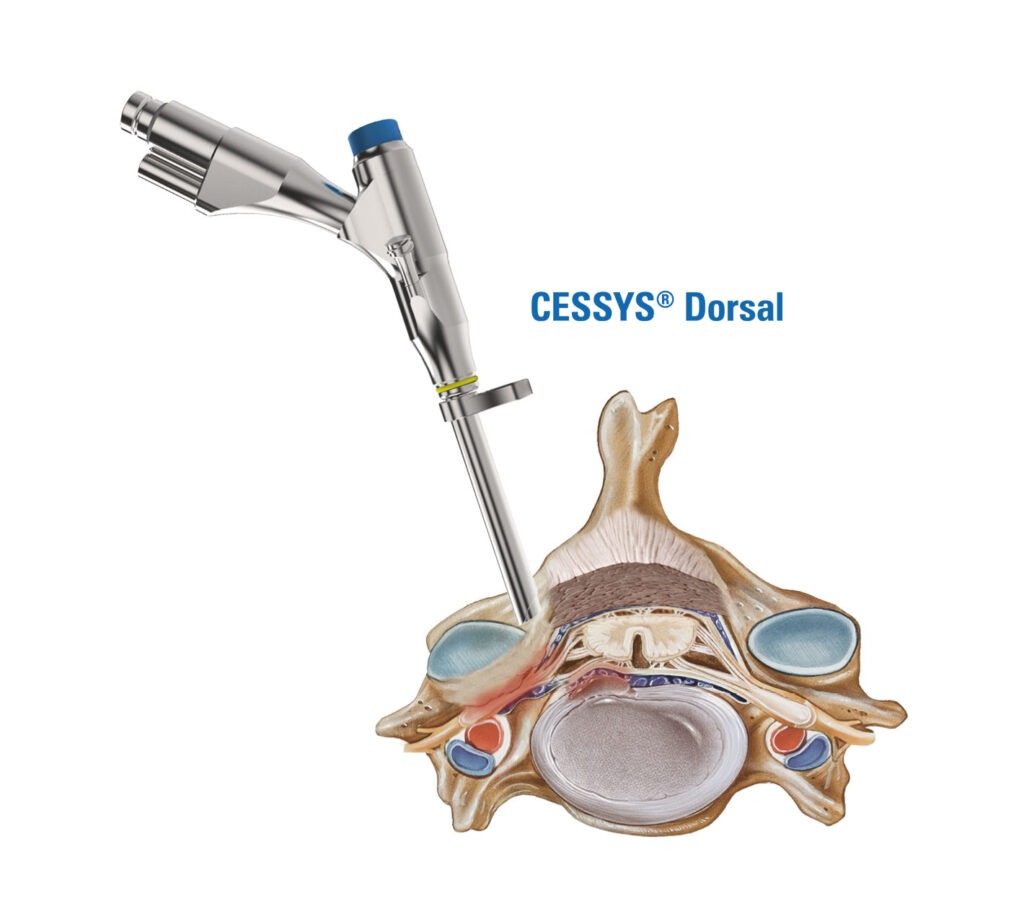 CESSYS-dorsal CESSYS-dorsal