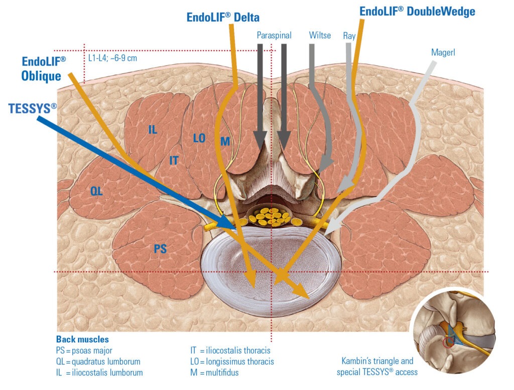 EndoLIF-Access EndoLIF-Access