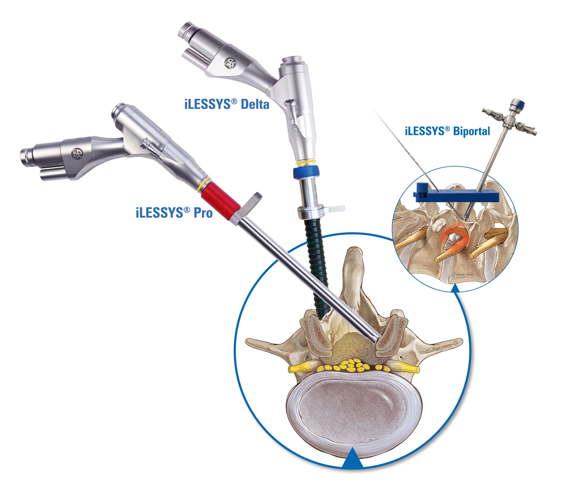 Interlaminar-surgery-systems Interlaminar-surgery-systems
