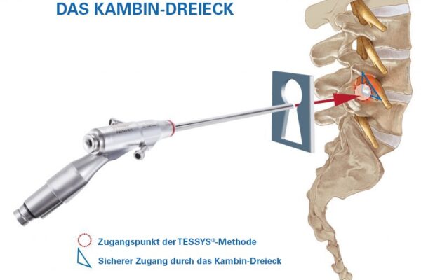 KambinTriangle-with-keyhole_DE-768x579 Anatomische Grafik von joimax zur erklärung des Zugangspunktes der transforaminalen TESSYS Methode durch das Kambin Dreieck .