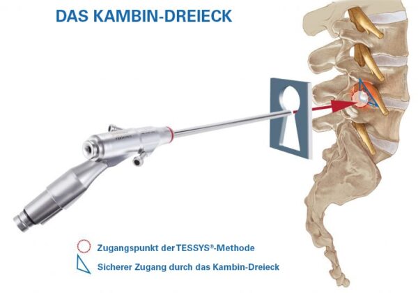 KambinTriangle-with-keyhole_DE-768x579 KambinTriangle-with-keyhole_DE-768x579
