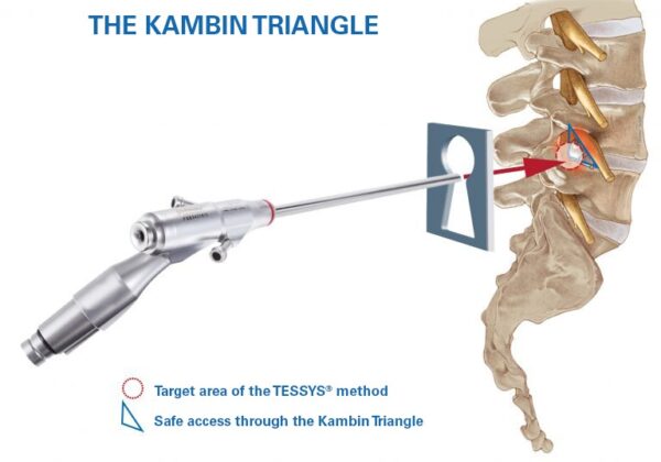 KambinTriangle-with-keyhole_EN-768x579 KambinTriangle-with-keyhole_EN-768x579