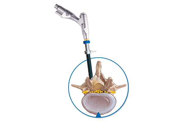 Produktvorstellung_ilessys delta Produktvorstellung_ilessys delta