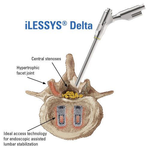 iLESSYS-Delta-Access