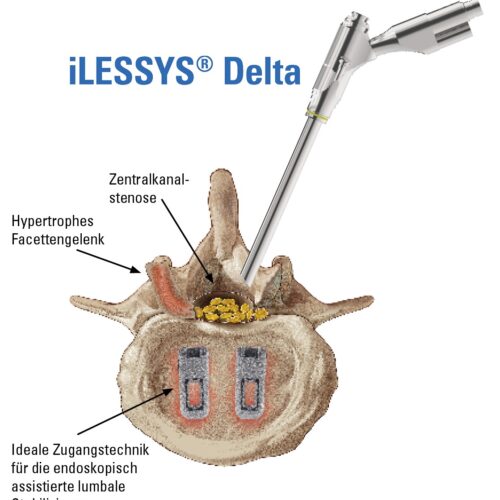 iLESSYS-Delta-Zugang