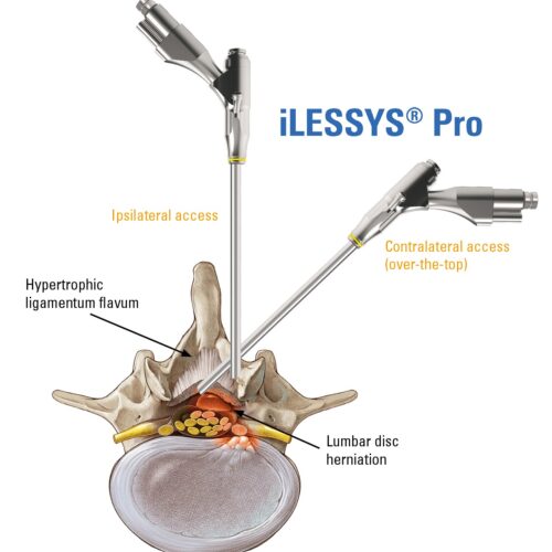 iLESSYS-Pro-Access