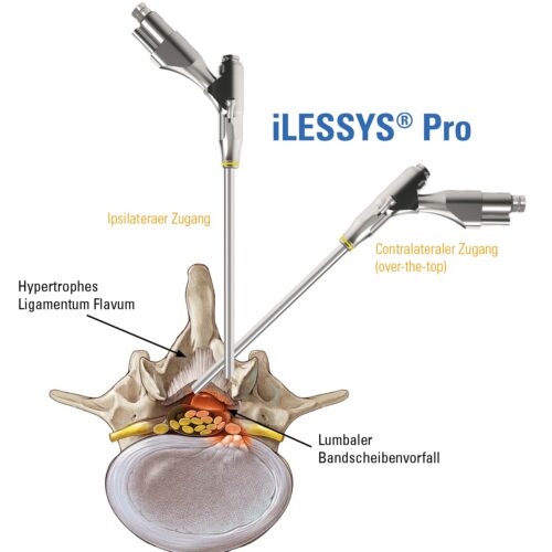 iLESSYS-Pro-Zugang