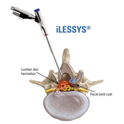 iLESSYS-Std-Access