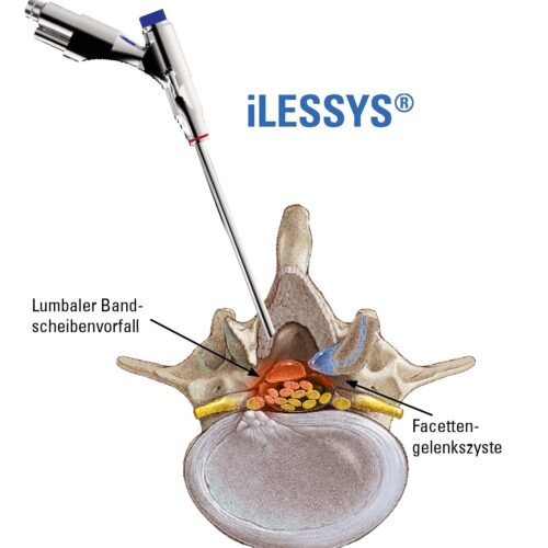 iLESSYS-Std-Zugang