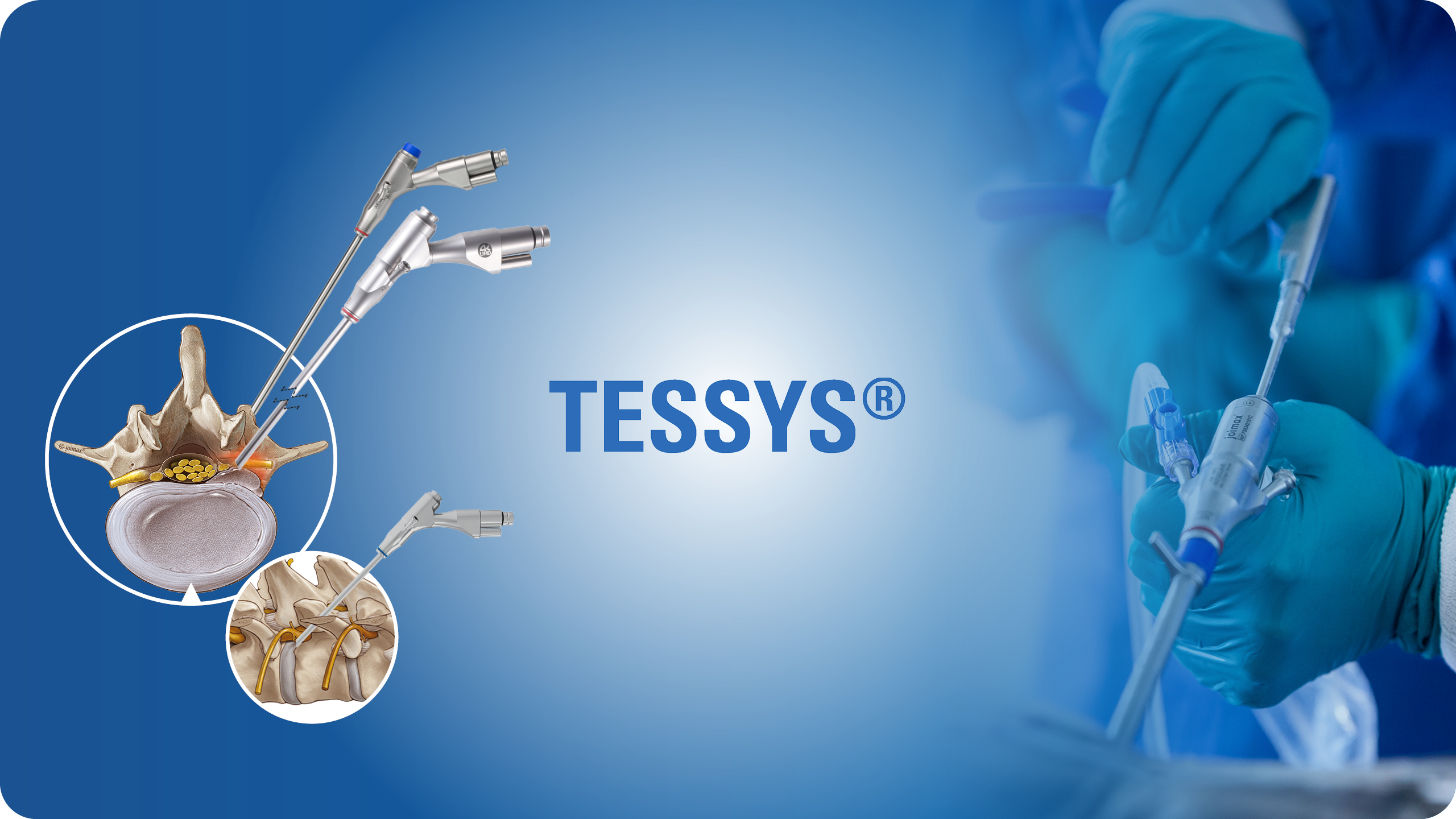 TESSYS Header Picture: TESSYS Logo in the middle, anatomical transforaminal access illustrations on the left and a OR Picture of a TESSYS Endoscope on the right