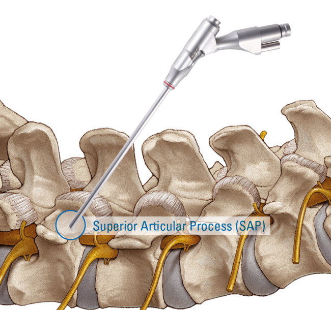 TESSYS® TransSAP TESSYS TransSAP Transforaminal Endoscopic Surgical System by joimax. An anatomical illustration of an endoscope targeting targets the superior articular process of a human spine.