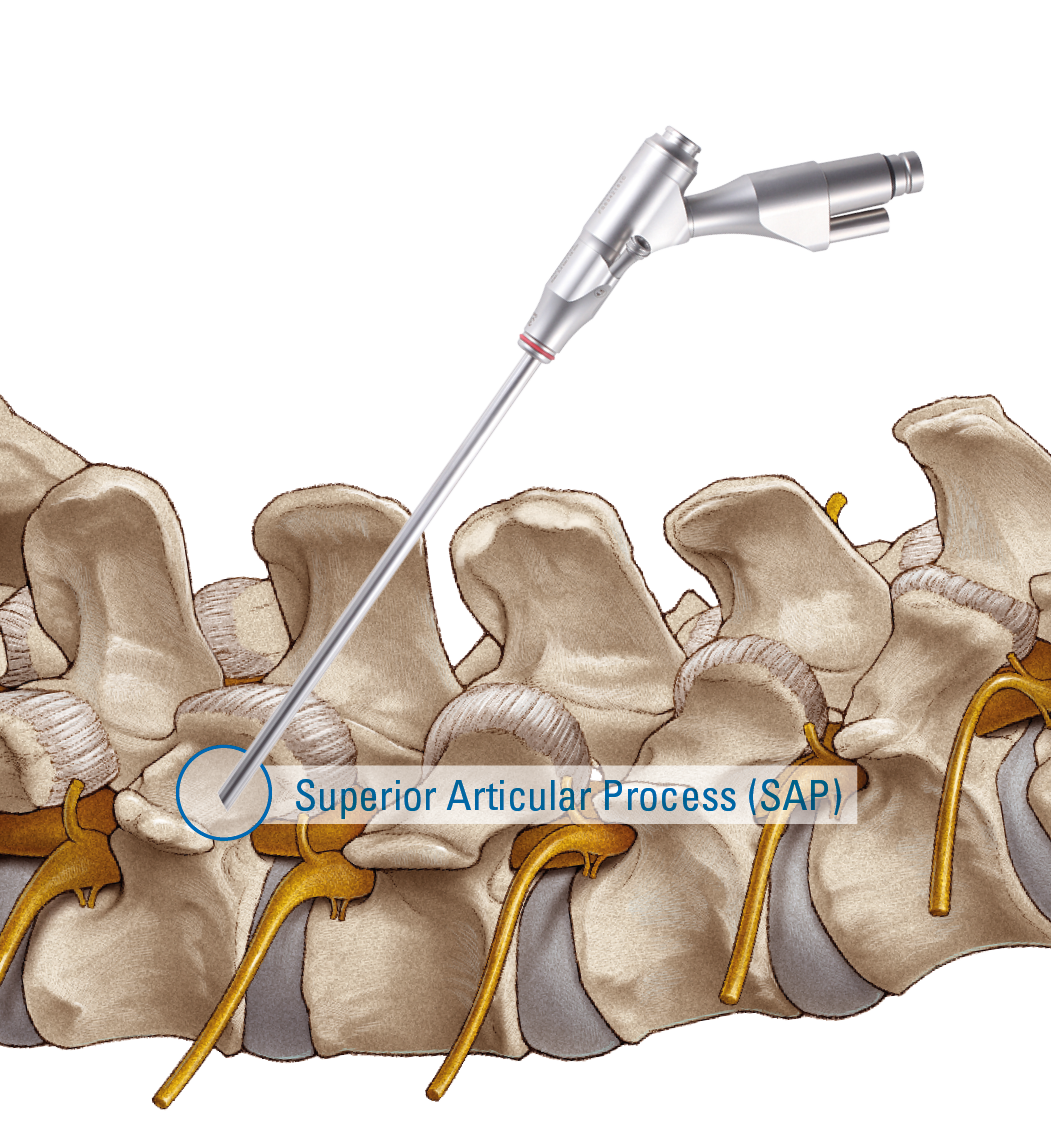 TESSYS® TransSAP TESSYS TransSAP Transforaminal Endoscopic Surgical System by joimax. An anatomical illustration of an endoscope targeting targets the superior articular process of a human spine.