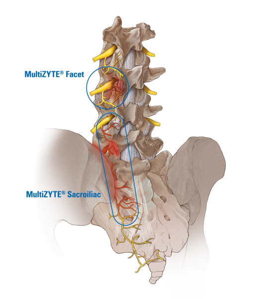 MultiZYTE® Facet and Sacroiliac Joint Treatment anatomical illustration of a lumbar human spine and a joimax endoscope, as symbol picture for treating Facet and Sacroiliac Joint Treatment with MultiZYTE