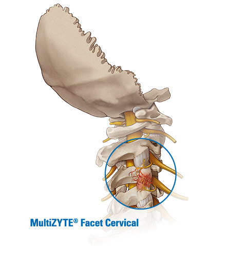 MultiZYTE Facet Cervical